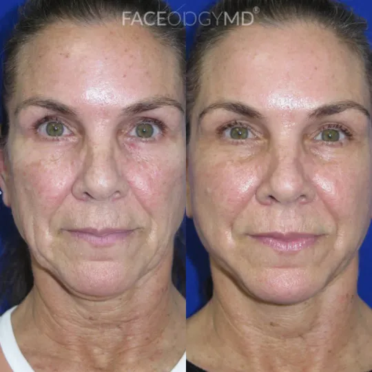Front View CO Laser before and after by Faceology MD