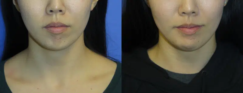 Front View Chin Implant before and after by Faceology MD