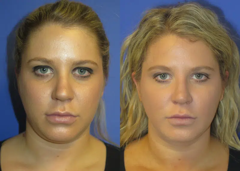 Front View Chin Liposuction before and after by Faceology MD