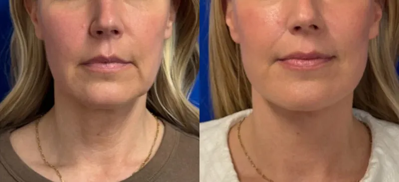 Front View Facelift & CO Laser before and after by Faceology MD