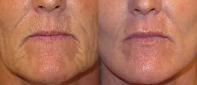 Front View Laser Resurfacing before and after by Faceology MD