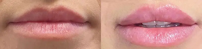 Front View Lip Filler before and after by Faceology MD