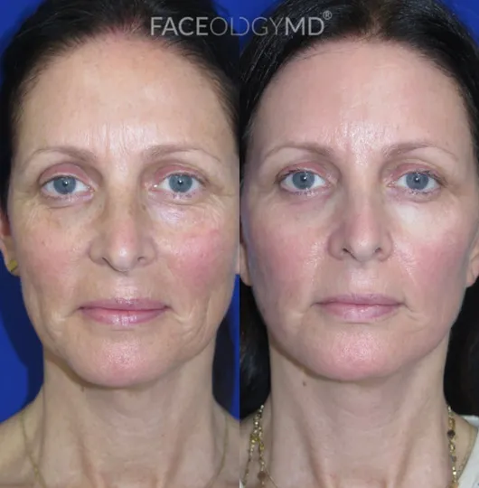 Front View Mini Facelift & Brow Lift before and after by Faceology MD
