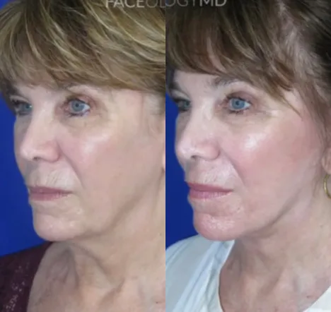 Left Oblique View CO Laser before and after by Faceology MD