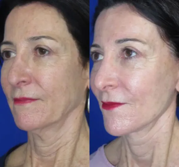 Left Oblique View CO Laser before and after by Faceology MD