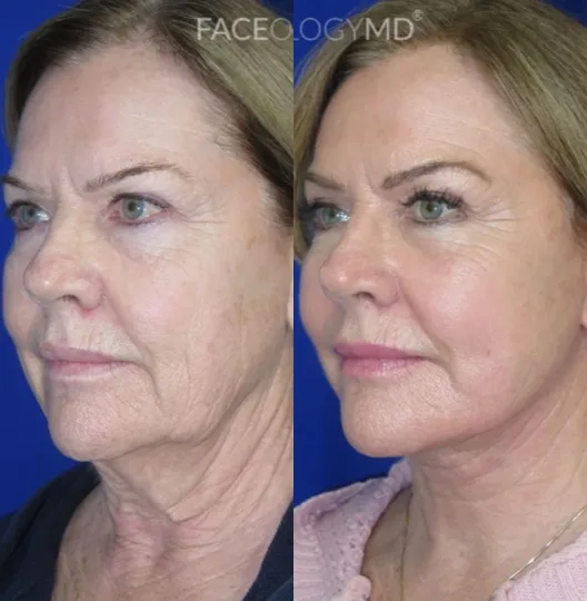 Left Oblique View CO Laser before and after by Faceology MD