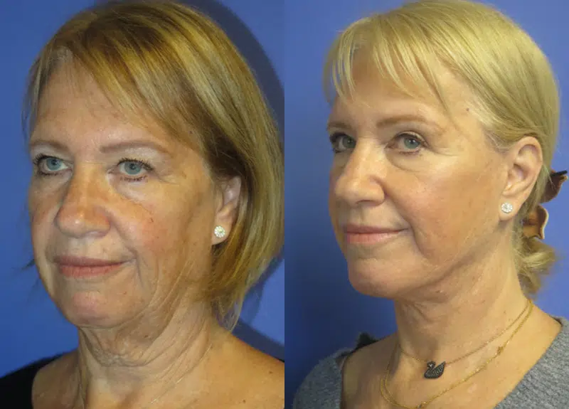 Left Oblique View Chin Implant before and after by Faceology MD
