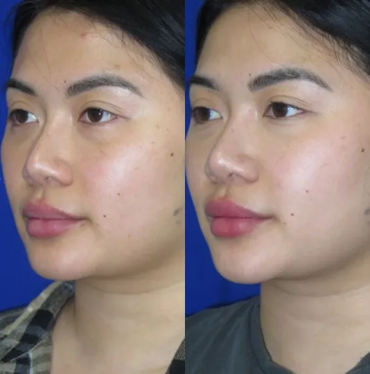 Left Oblique View Chin Liposuction before and after by Faceology MD