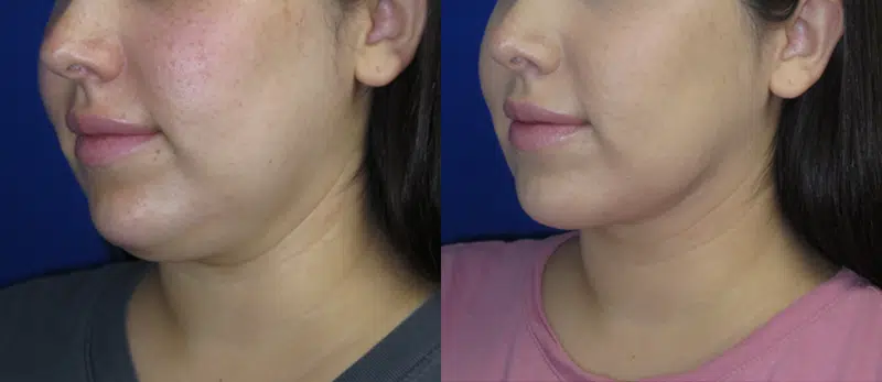Left Oblique View Chin Liposuction before and after by Faceology MD