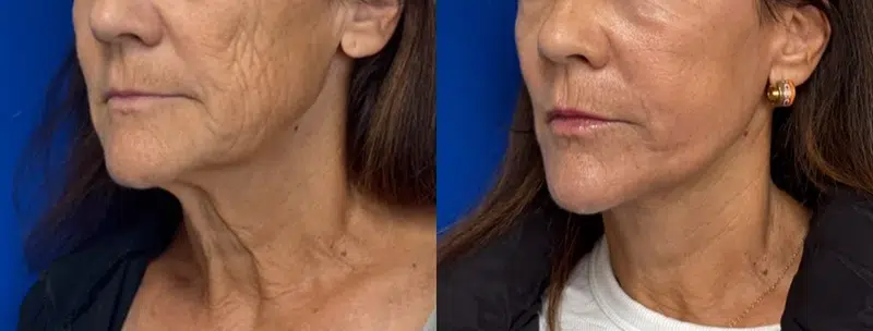 Left Oblique View Facelift & CO Laser before and after by Faceology MD