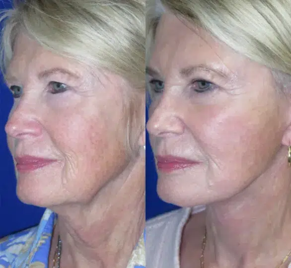 Left Oblique View Non Surgical Face & Neck Lift before and after by Faceology MD