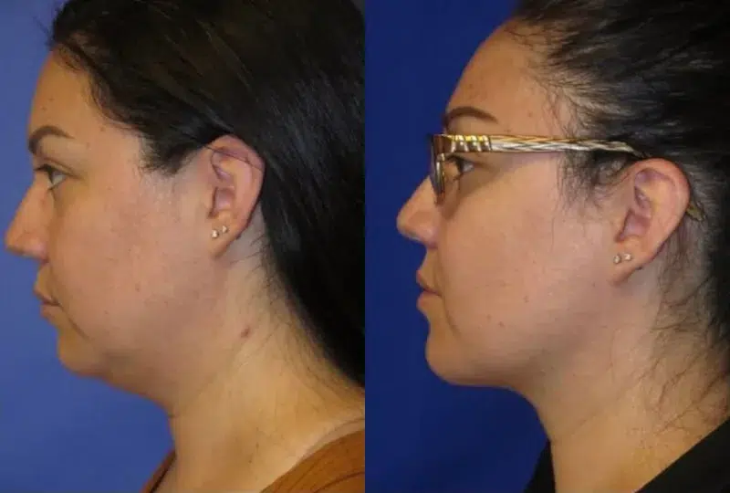 Left Side View Buccal Fat Removal before and after by Faceology MD