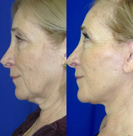 Left Side View CO Laser before and after by Faceology MD