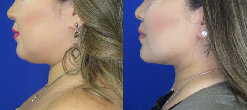 Left Side View Chin Liposuction before and after by Faceology MD