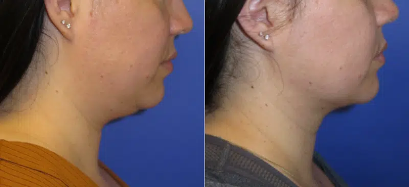 Left Side View Chin Liposuction before and after by Faceology MD