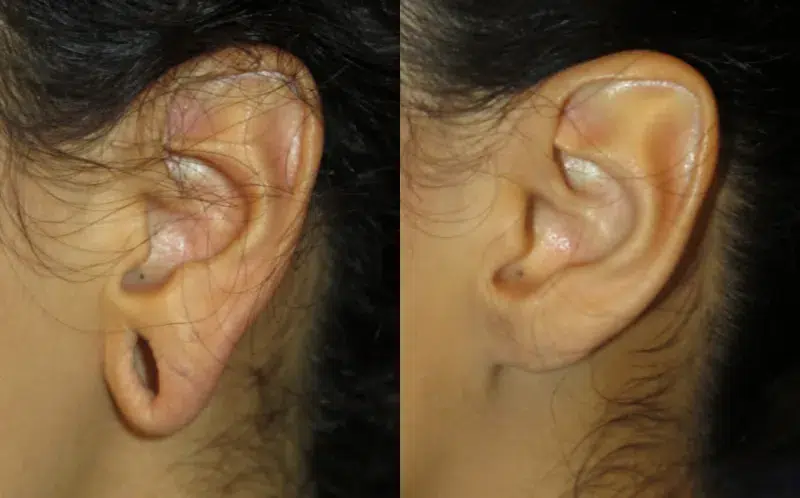Left Side View Earlobe Repair before and after by Faceology MD