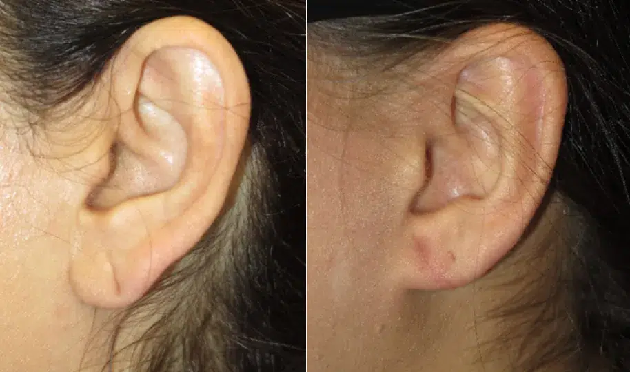 Left Side View Earlobe Repair before and after by Faceology MD