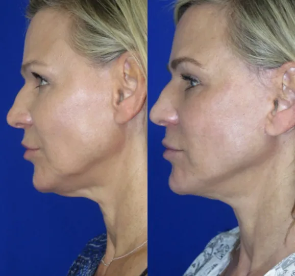 Left Side View Non Surgical Face & Neck Lift before and after by Faceology MD