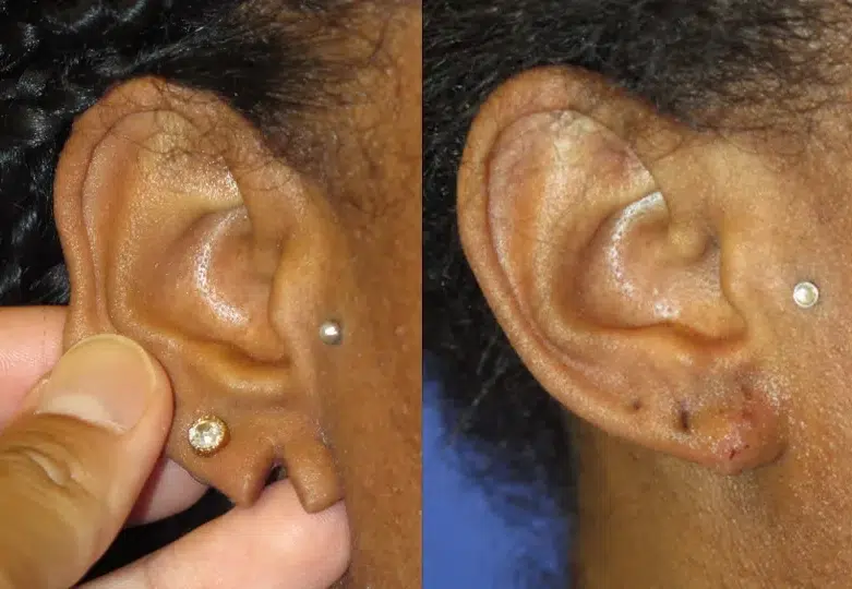 Right CloseUp Side View Earlobe Repair before and after by Faceology MD