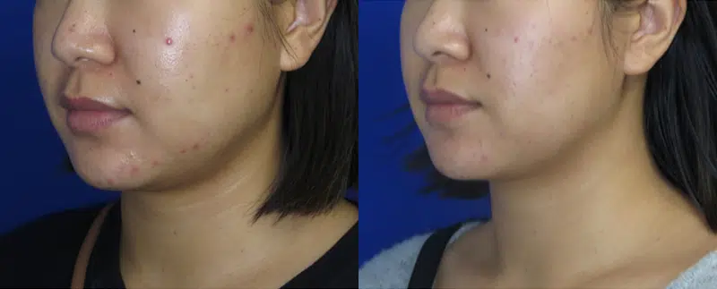 Right Oblique View Buccal Fat Removal before and after by Faceology MD