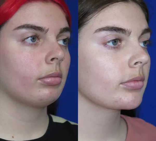 Right Oblique View Chin Implant before and after by Faceology MD