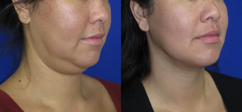 Right Oblique View Chin Liposuction before and after by Faceology MD