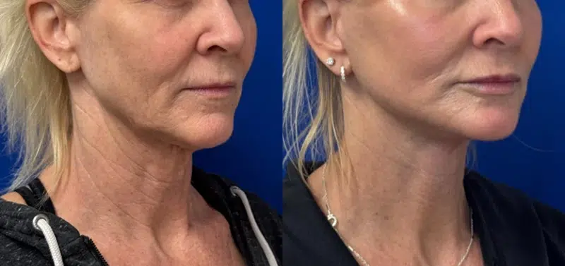 Right Oblique View Facelift & CO Laser before and after by Faceology MD
