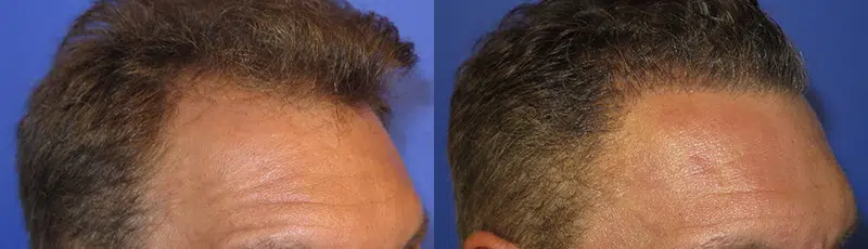 Right Oblique View Hair Transplant before and after by Faceology MD