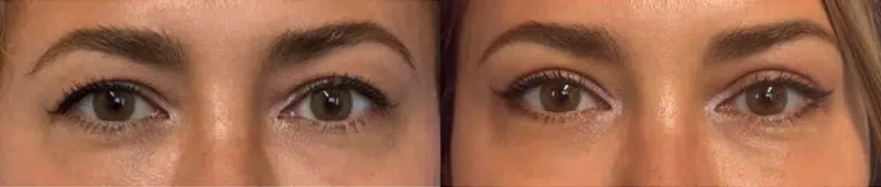 Right Side View Eyelid Surgery before and after by Faceology MD