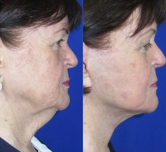 Right Side View CO Laser before and after by Faceology MD