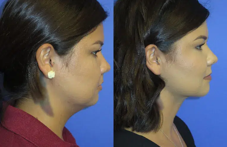 Right Side View Chin Liposuction before and after by Faceology MD