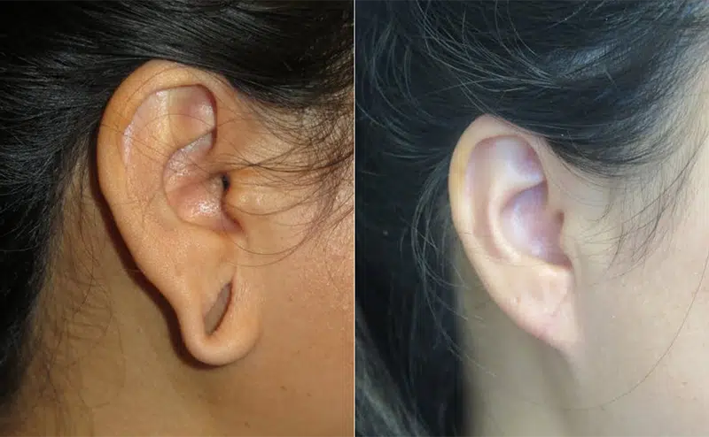 Right Side View Earlobe Repair before and after by Faceology MD