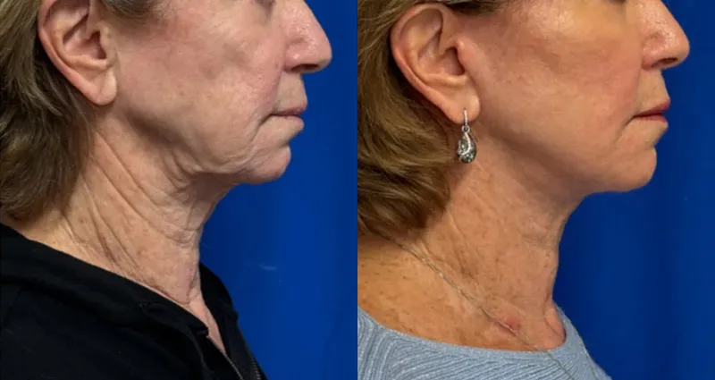 Right Side View Facelift & CO Laser before and after by Faceology MD