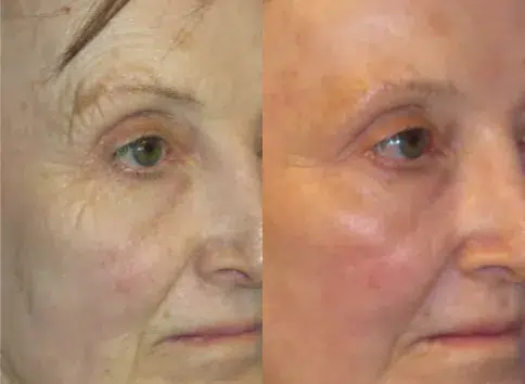 Right Side View Laser Resurfacing before and after by Faceology MD
